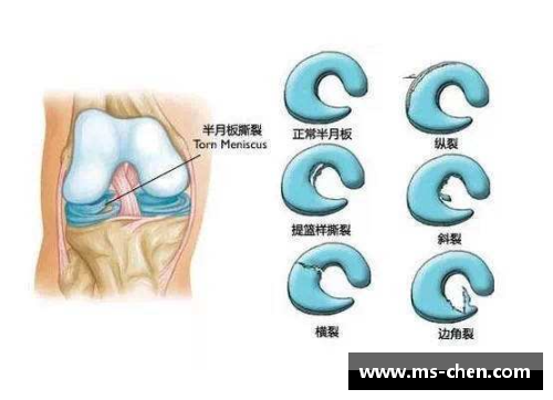 体育明星半月板手术恢复之路解析如何重返赛场的挑战与希望